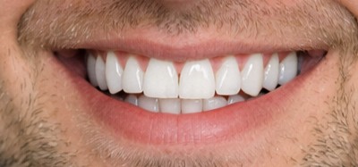 Якісна імплантація зубів у Луцьку